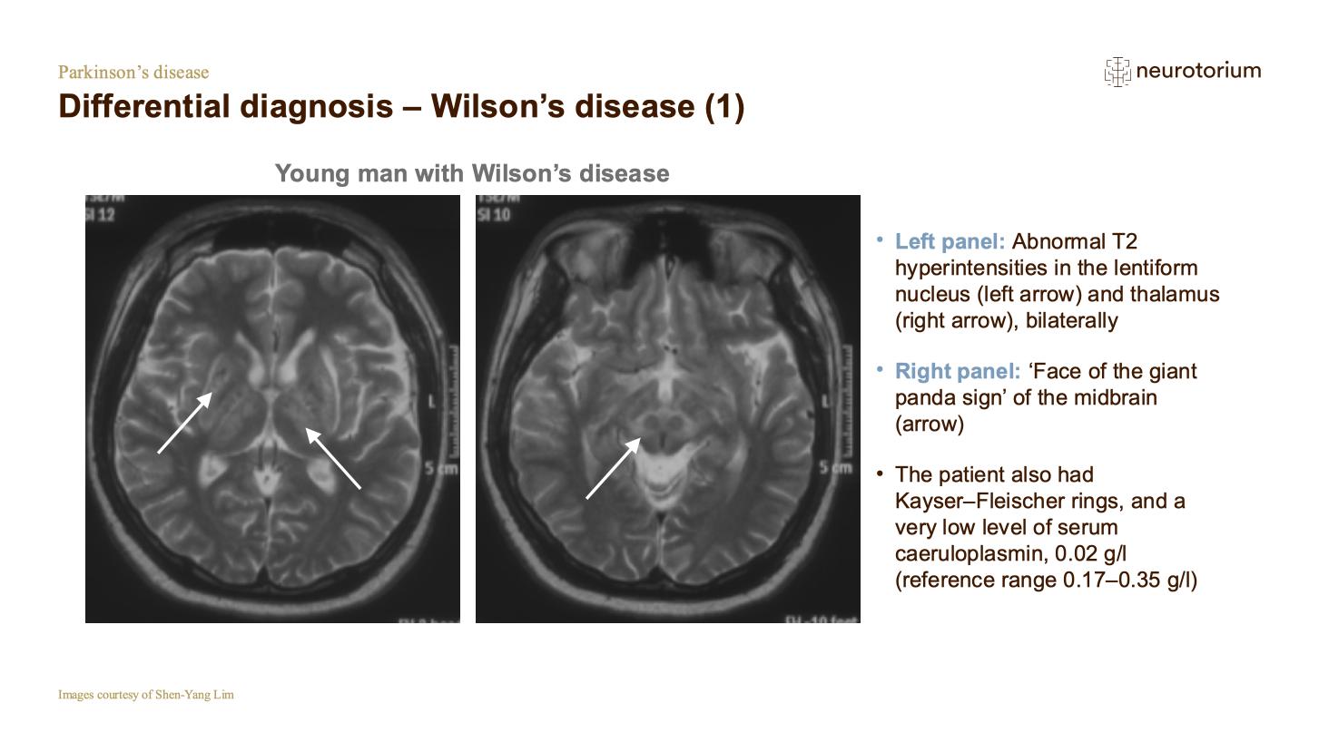 Parkinsons Disease – History Definitions and Diagnosis – slide 21